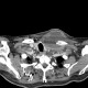 Metastatic infiltration of lymph node, osteolysis of clavicle: CT - Computed tomography