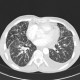 Interstitial edema of the lung: CT - Computed tomography