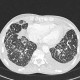 Interstitial edema of the lung: CT - Computed tomography