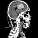 Intracerebral hemorrhage, semioval center: CT - Computed tomography