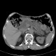 Intrapapillary mucinous neoplasm of pancreas, IPMN, IPMT, main duct type: CT - Computed tomography