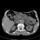 Intrapapillary mucinous neoplasm of pancreas, IPMN, IPMT, main duct type: CT - Computed tomography