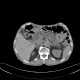 Intrapapillary mucinous neoplasm of pancreas, IPMN, IPMT, main duct type: CT - Computed tomography