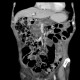Intrapapillary mucinous neoplasm of pancreas, IPMN, IPMT, main duct type: CT - Computed tomography