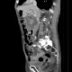 Intrapapillary mucinous neoplasm of pancreas, IPMN, IPMT, main duct type: CT - Computed tomography