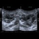 Intrapapillary mucinous neoplasm of pancreas, IPMN, IPMT, main duct type: US - Ultrasound