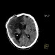 Cerebral ischemia, craniotomy, subarachnoid hemorrhage: CT - Computed tomography