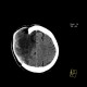 Cerebral ischemia, craniotomy, subarachnoid hemorrhage: CT - Computed tomography