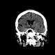 Stroke, cerebral ischemia, insula, caudate: CT - Computed tomography