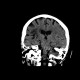 Stroke, cerebral ischemia, insula, caudate: CT - Computed tomography