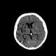 Stroke, cerebral ischemia, insula, caudate: CT - Computed tomography