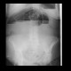 Ileus, small bowel: X-ray - Plain radiograph