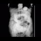 Small bowel obstruction, ileus, Crohn's disease: RF - Fluoroscopy