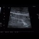 Small bowel obstruction, ileus, Crohn's disease: US - Ultrasound