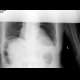 Small bowel ileus: X-ray - Plain radiograph