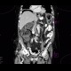 Constipation, large bowel obstruction, low grade: CT - Computed tomography