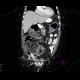 Constipation, large bowel obstruction, low grade: CT - Computed tomography