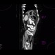 Constipation, large bowel obstruction, low grade: CT - Computed tomography