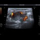 Tumorous infiltration of lymph node: US - Ultrasound