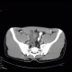 Acute appendicitis, periappendiceal infiltrate: CT - Computed tomography