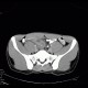 Acute appendicitis, periappendiceal infiltrate: CT - Computed tomography