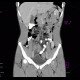 Acute appendicitis, periappendiceal infiltrate: CT - Computed tomography
