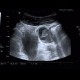Acute appendicitis, periappendiceal infiltrate: US - Ultrasound