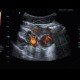 Acute appendicitis, periappendiceal infiltrate: US - Ultrasound
