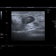 Tumorous infiltration of lymph node: US - Ultrasound