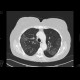 Interstitial pneumonia, HRCT: CT - Computed tomography
