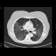 Interstitial pneumonia, HRCT: CT - Computed tomography