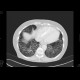 Interstitial pneumonia, HRCT: CT - Computed tomography