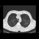 Thickening of intralobular interstitium, HRCT: CT - Computed tomography