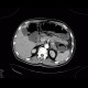 Ischemia of large bowel: CT - Computed tomography