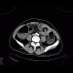 Ischemia of large bowel: CT - Computed tomography