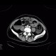 Ischemia of large bowel: CT - Computed tomography
