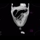 Ischemia of large bowel: CT - Computed tomography