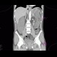 Ischemia of large bowel: CT - Computed tomography