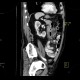 Jejunal diverticulitis, diverticulosis: CT - Computed tomography