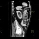 Jejunal diverticulitis, diverticulosis: CT - Computed tomography