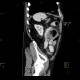 Jejunal diverticulitis, diverticulosis: CT - Computed tomography
