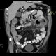 Jejunal diverticulitis, diverticulosis: CT - Computed tomography