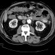 Jejunal diverticulitis, diverticulosis: CT - Computed tomography