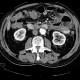 Jejunal diverticulitis, diverticulosis: CT - Computed tomography