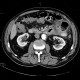 Jejunal diverticulitis, diverticulosis: CT - Computed tomography