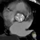 Aortic valve, calcified aortic valve: CT - Computed tomography