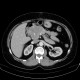 Carcionoid, pancreas, head of pancreas, calcification: CT - Computed tomography