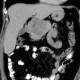 Carcionoid, pancreas, head of pancreas, calcification: CT - Computed tomography