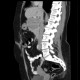 Carcionoid, pancreas, head of pancreas, calcification: CT - Computed tomography