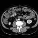 Carcinoid of terminal ileum, mesentery, desmoplastic reaction, prestenotic dilatation: CT - Computed tomography
